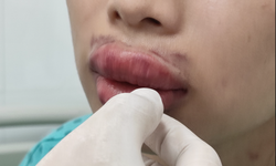 M&#244;i sưng phồng, bầm t&#237;m sau khi ti&#234;m filler x&#243;a nhăn