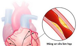 B&#224;i thuốc từ linh chi hỗ trợ điều trị bệnh mạch v&#224;nh