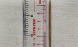 Bị thủng ruột do ngậm tăm