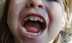 Sử dụng thuốc chống vi&#234;m c&#243; thể g&#226;y biến đổi men răng ở trẻ