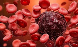 8 biểu hiện của ung thư m&#225;u v&#224; c&#225;ch chữa căn bệnh n&#224;y