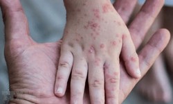 Đà Nẵng phát hiện trường hợp nghi mắc đậu mùa khỉ đầu tiên