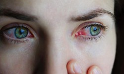 Khi nào dùng kháng sinh trị đau mắt đỏ?