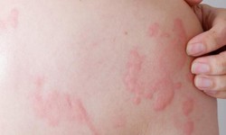 C&#225;ch xử l&#253; với bệnh mề đay do lạnh