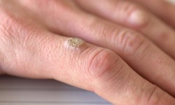 Mụn c&#243;c ở tay c&#243; l&#226;y sang bộ phận sinh dục kh&#244;ng?