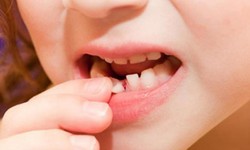 5 lưu &#253; quan trọng khi thay răng sữa ở trẻ