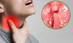 Cần ph&#225;t hiện sớm bệnh bạch hầu để tr&#225;nh g&#226;y tử vong