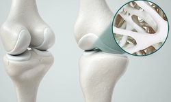 Hỗ trợ nâng cao sức khoẻ sụn khớp với collagen type II