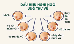 10 biện ph&#225;p gi&#250;p giảm nguy cơ ung thư v&#250;