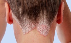 Thuốc chữa vẩy nến c&#243; thể kiểm so&#225;t rối loạn sử dụng rượu