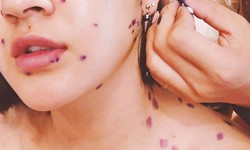 Biến chứng nguy hiểm của thủy đậu