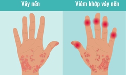 Bị vi&#234;m khớp vảy nến n&#234;n l&#224;m g&#236;?