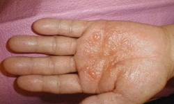 Bệnh tổ đỉa: Nguy&#234;n nh&#226;n v&#224; c&#225;c phương ph&#225;p điều trị