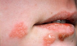 Cảnh báo gia tăng các bệnh lây truyền qua đường tình dục, vi khuẩn gây bệnh lậu kháng thuốc