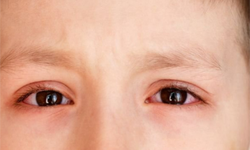 Ngứa mắt v&#224; đau mắt đỏ c&#243; thể l&#224; triệu chứng mới của COVID-19