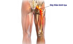Liệu ph&#225;p mới gi&#250;p giảm đau thần kinh tọa