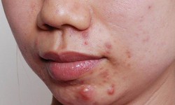 C&#225;c chất bổ sung hỗ trợ điều trị mụn trứng c&#225;