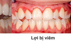 Vi&#234;m lợi: Nguy&#234;n nh&#226;n, biểu hiện v&#224; điều trị