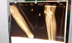 Bị tai nạn giao thông, cụ ông 71 tuổi gãy xương cẳng chân phức tạp