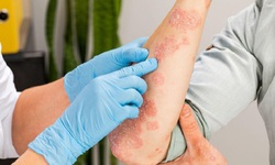 Điều trị vi&#234;m đa cơ, vi&#234;m da cơ tự miễn