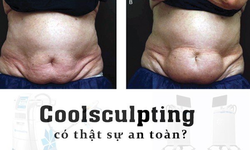 Điều trị Paradoxical Adipose Hyperplasia v&#224; loại bỏ phương ph&#225;p đ&#244;ng lạnh hủy mỡ Coolsculpting tại Bệnh viện AVA  