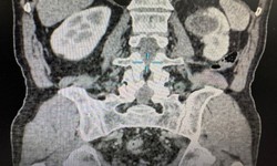 Đau thắt lưng, kh&#225;m ph&#225;t hiện mắc nang thận nguy cơ ung thư