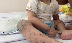 5 dấu hiệu cần cho trẻ mắc tay chân miệng nhập viện gấp