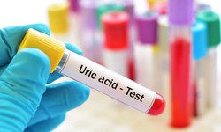 X&#233;t nghiệm acid uric tăng liệu c&#243; phải mắc bệnh gout?