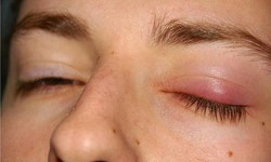 Lựa chọn c&#225;c thuốc điều trị bệnh chắp mắt