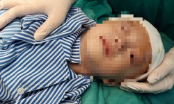 Ngã từ độ cao 2m, bé trai 20 tháng bị lún sọ