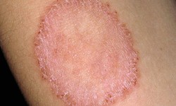 Bệnh hắc l&#224;o: Nguy&#234;n nh&#226;n v&#224; c&#225;ch ph&#242;ng ngừa