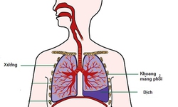 Tr&#224;n dịch m&#224;ng phổi: Nguy&#234;n nh&#226;n, biểu hiện v&#224; điều trị