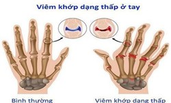 B&#224;i thuốc điều trị vi&#234;m khớp dạng thấp