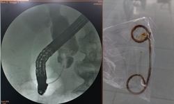 Nam bệnh nh&#226;n bỏ qu&#234;n stent trong đường mật suốt 2 năm