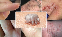 M&#249;a h&#232; cảnh gi&#225;c với bệnh C&#225;i ghẻ