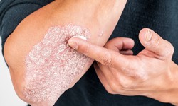 D&#249;ng thuốc chống vi&#234;m b&#244;i trị bệnh vảy nến sao cho an to&#224;n?