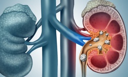 Sỏi thận: Nguyên nhân, dấu hiệu và cách điều trị