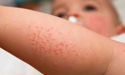 Cách chữa sẩn ngứa ở trẻ em