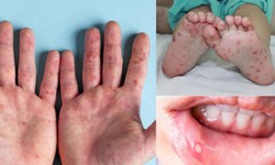 Cách phân biệt nốt phỏng nước tay chân miệng với bệnh thủy đậu