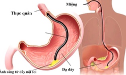 Nội soi ti&#234;u h&#243;a cho trẻ cần ch&#250; &#253; những g&#236;?