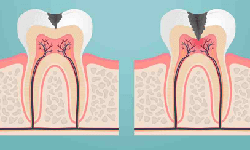 Những biến chứng nguy hiểm của vi&#234;m tủy răng