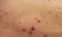 Xuất huyết giảm tiểu cầu c&#243; chữa khỏi kh&#244;ng v&#224; cần l&#224;m x&#233;t nghiệm g&#236;?