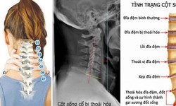 C&#225;ch l&#224;m gối thuốc chữa bệnh tho&#225;i h&#243;a cột sống cổ