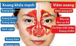 Thực dưỡng cho người bệnh vi&#234;m xoang