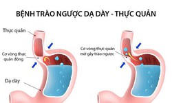 Trị tr&#224;o ngược dạ d&#224;y thực quản bằng thuốc đ&#244;ng y