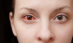 B&#224;i thuốc trị đau mắt đỏ từ khi bệnh mới chớm