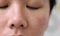 3 c&#225;ch khắc phục da th&#226;m sạm, sần s&#249;i tại nh&#224;