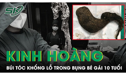 Kinh ho&#224;ng với b&#250;i t&#243;c khổng lồ trong bụng b&#233; g&#225;i 10 tuổi