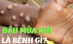 Từ 2 ca đậu m&#249;a khỉ mới ph&#225;t hiện, cần biết 4 điều sau để giảm nguy cơ l&#226;y nhiễm