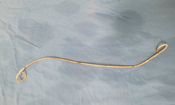 Ống Sonde JJ bị cụ b&#224; bỏ qu&#234;n 4 năm trong cơ thể